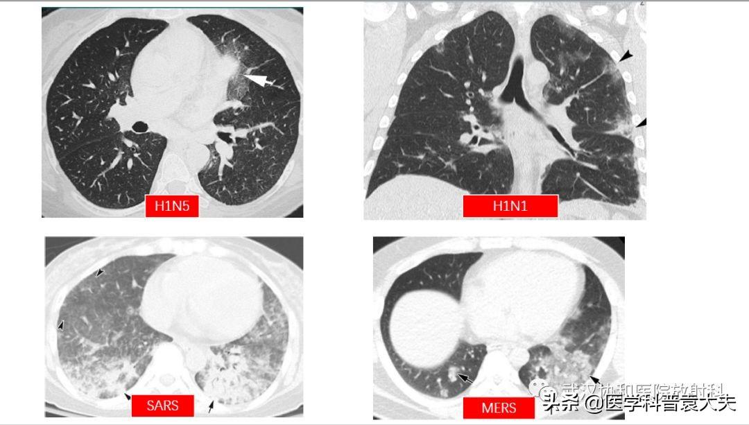 新型冠状肺炎最新情况深度解析